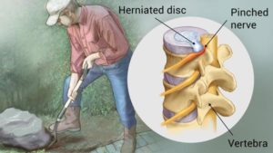 Yoga poses for sciatica pain- Herniated disc